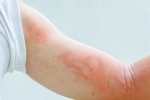 dermatological symptoms, symptoms, dermatological symptoms could be a sign for covid 19 infection, Dry cough