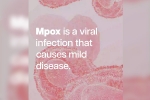 mpox break down, mpox in Congo, mpox emergency again, Safe sex