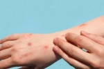 Monkeypox symptoms, Monkeypox latest updates, study says that the symptoms of monkeypox are different from earlier, Monkeypox