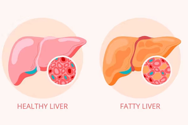 How to Reverse Grade 2 Fatty Liver? How to Reverse Grade 2 Fatty Liver?